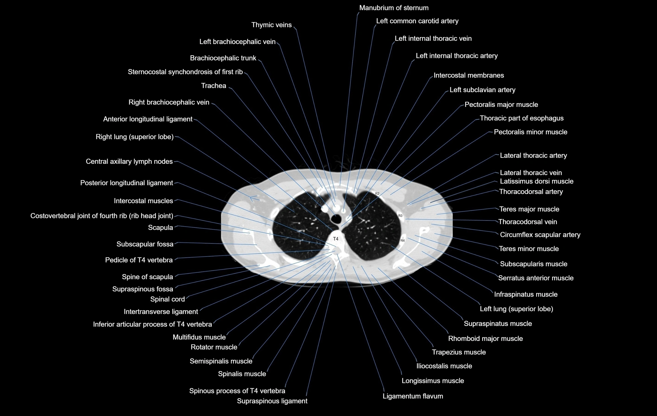 CT chest (thorax) lung window window labelled axial cross sectional anatomy radiology image-00027.webp